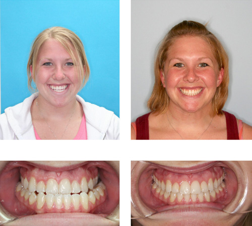 Before & After - 11 months, surgery and SureSmile - Moles & Ferri Orthodontics