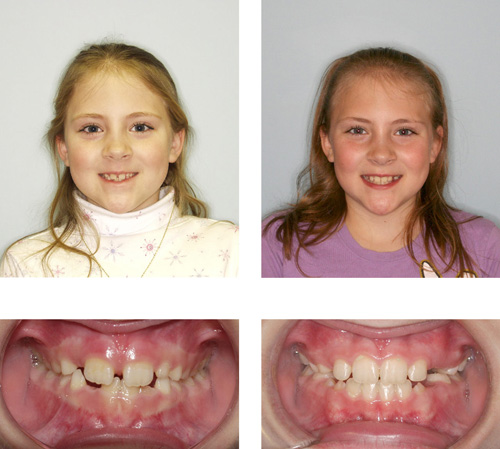 Before & After - 14 months, Phase I child - Moles & Ferri Orthodontics