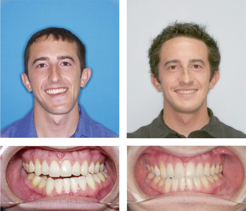 Before & After - 18 months, surgery and SureSmile - Moles & Ferri Orthodontics