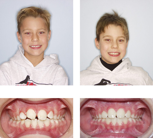 Before & After - 12 months, Phase I child - Moles & Ferri Orthodontics