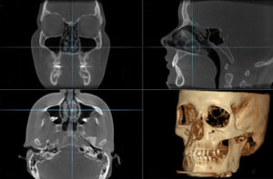 x-rays of skull