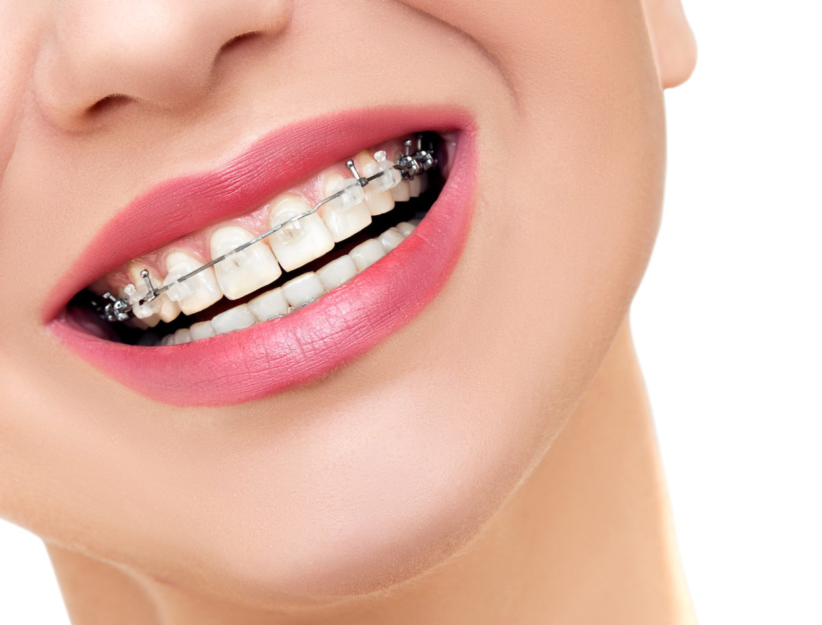 Closeup Braces on Teeth. Woman Smile with Orthodontic Braces.