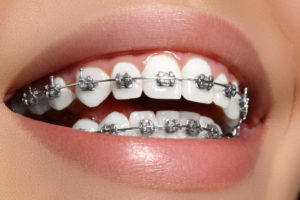 white teeth with braces