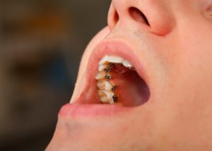 Close up of a lingual braces at a dental clinic