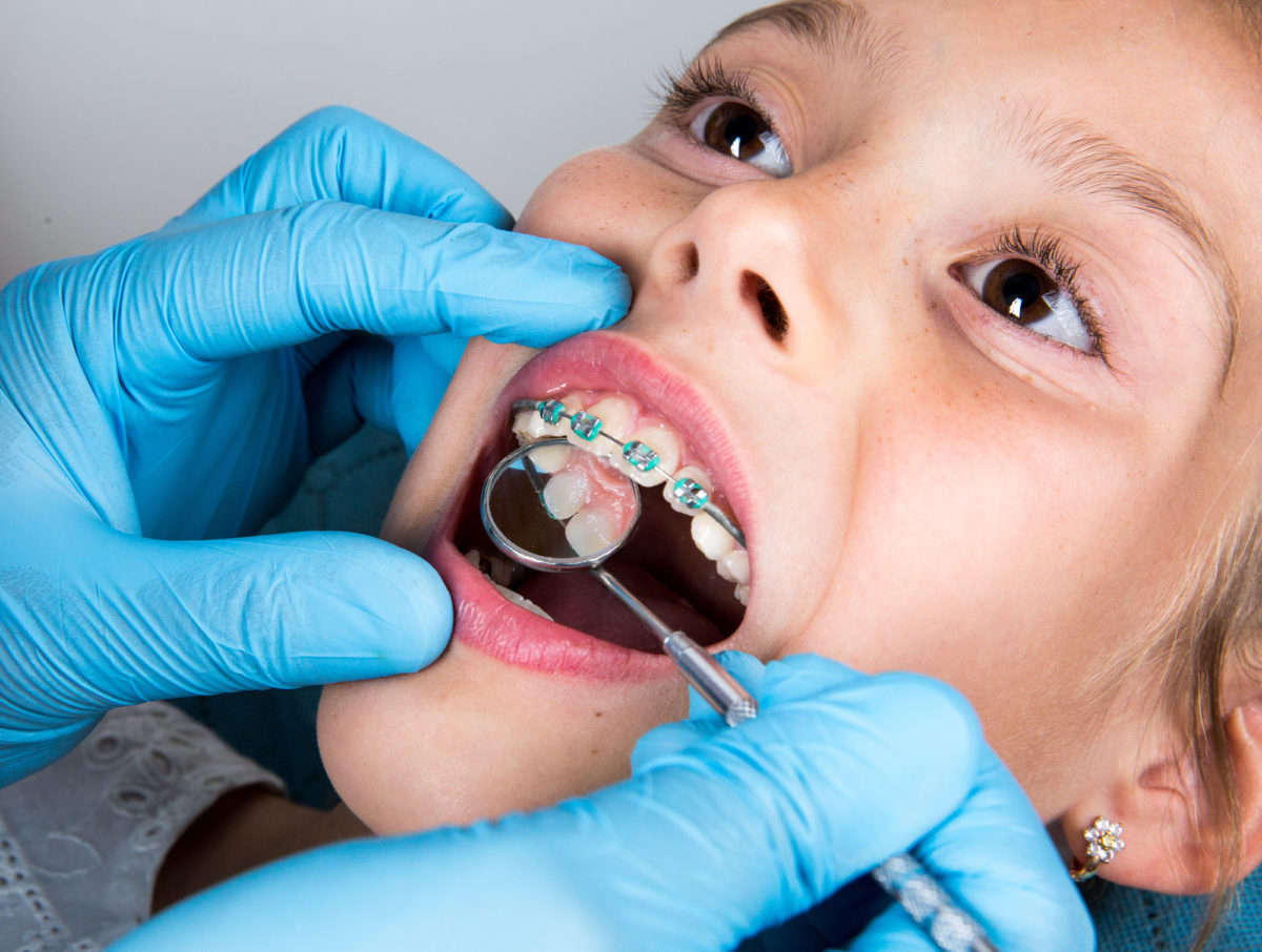 Dentist, Orthodontist examining a little girl patient's teeth with green braces. Close up of girl head and dentist, orthodontist hands with blue gloves
