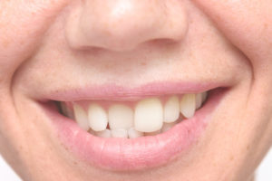 close up shot of crooked teeth