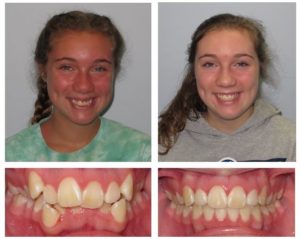 before & after orthodontic work