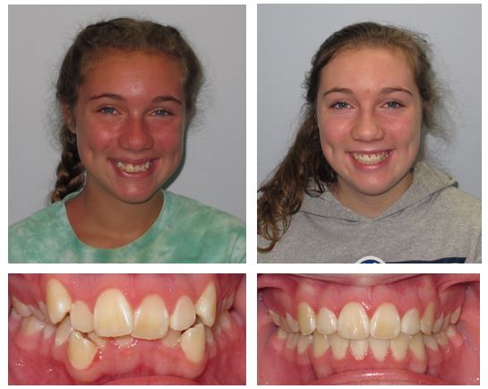 Before & After - 7 months, SureSmile - Moles & Ferri Orthodontics